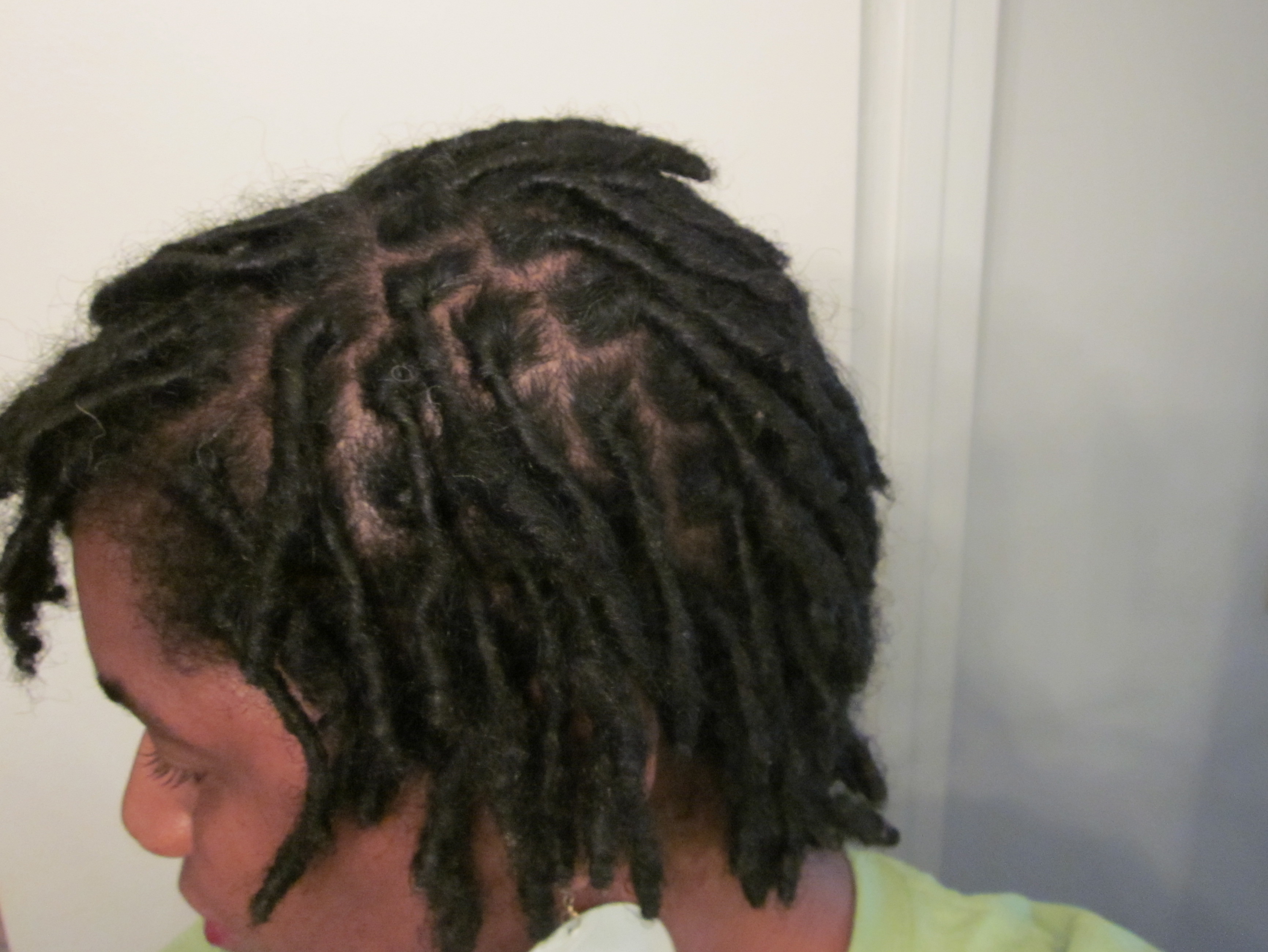 dry itchy scalp with dreads